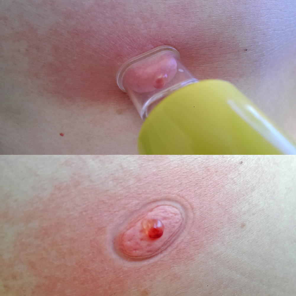 EXTRACTOR PUMP - Extractor Pump Kit for Venom Extraction 4